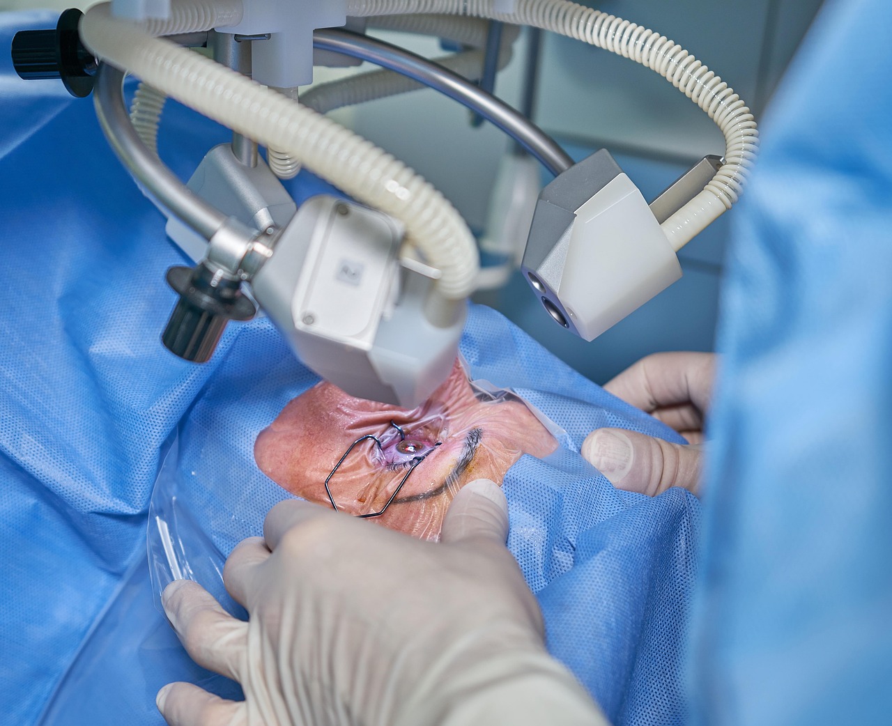 Cataract Surgery